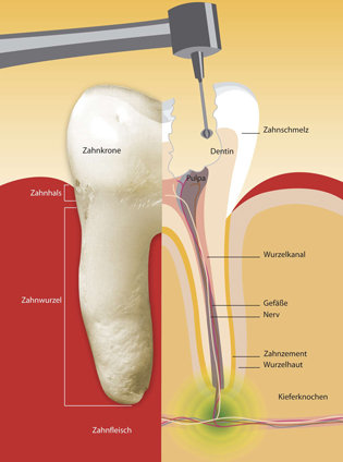 Wurzelbehandlung 2