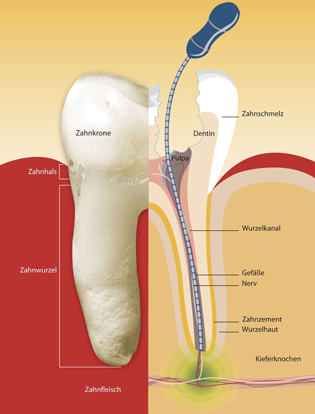 Wurzelbehandlung 3